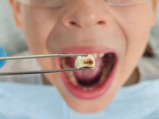 Best Broken or Cracked Tooth Emergency Dentist in Centerville, IA